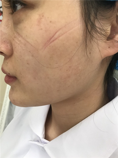 1580723659137697.jpg 被防护用品勒出深深勒痕的韦青.jpg